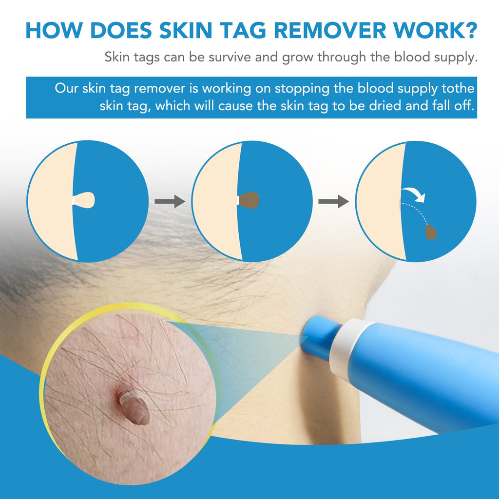 2 IN 1 Auto Skin Tag Remover Kit - magsofter
